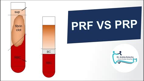 prf centrifuge machine|platelet rich fibrin vs prp.